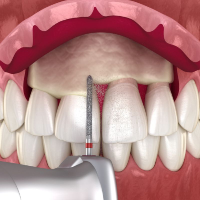 Crown lengthening is a surgical procedure aimed at reshaping the gum tissue and bone to expose more of the tooth's surface.