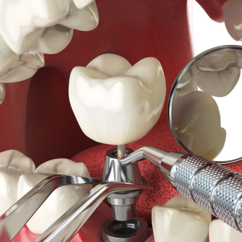 Dental Implant Services by Implants Network 3d rendered photo