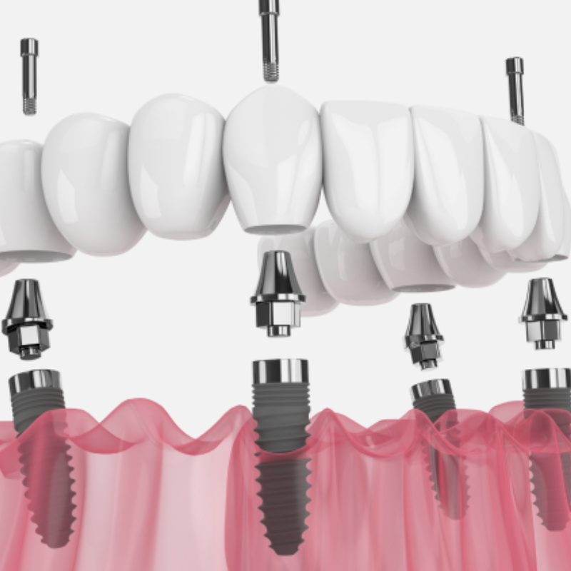 Full Mouth Implants (All-on-X)