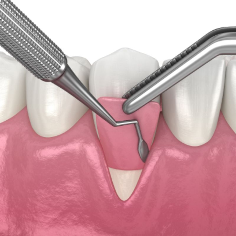 Gum grafting is an effective solution for addressing gum recession. This procedure helps protect exposed tooth roots from decay, reduces sensitivity, and enhances the overall aesthetics of your smile.