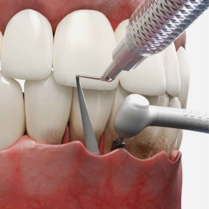 Pocket reduction surgery is a standard intervention for advanced periodontal disease. This procedure reduces the depth of gum pockets around teeth, helping to remove harmful bacteria and tartar build-up. By addressing these deep pockets, we can prevent further gum and bone loss and promote better oral hygiene.