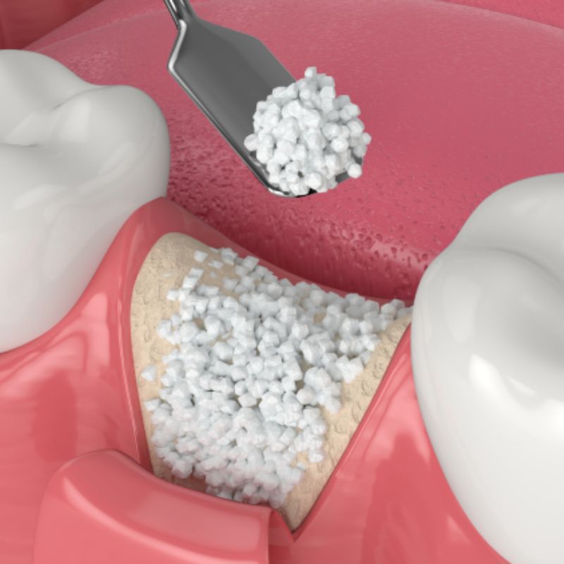 Implants Network regenerative procedures are vital for restoring both function and aesthetics to your oral health. These treatments, which include hard and soft tissue regeneration, are often necessary for complete oral rehabilitation. Our skilled doctors utilize advanced techniques and detailed 3D imaging to ensure precise and effective outcomes. Hard Tissue Regeneration: Socket grafting Alveolar ridge augmentation Sinus lifts (direct or indirect) Ridge split bone augmentation Various bone grafting techniques Soft Tissue Regeneration: Periodontal flap surgeries Guided tissue regeneration Connective tissue grafts Free gingival grafts Tunneling procedures