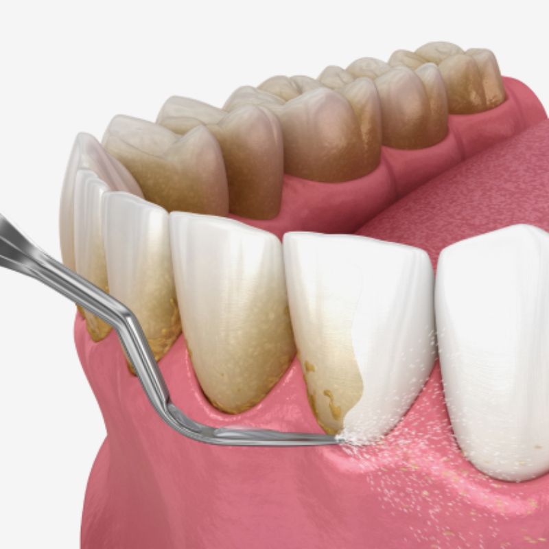 Scaling and root planning are essential treatments for combating gum disease. This deep cleaning procedure removes tartar and plaque from the tooth surfaces and beneath the gumline, helping to eliminate bacterial toxins and promote healthy gum tissue reattachment.