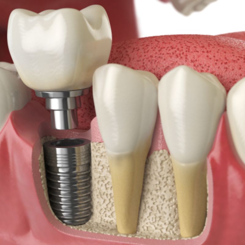 Single Tooth Replacement