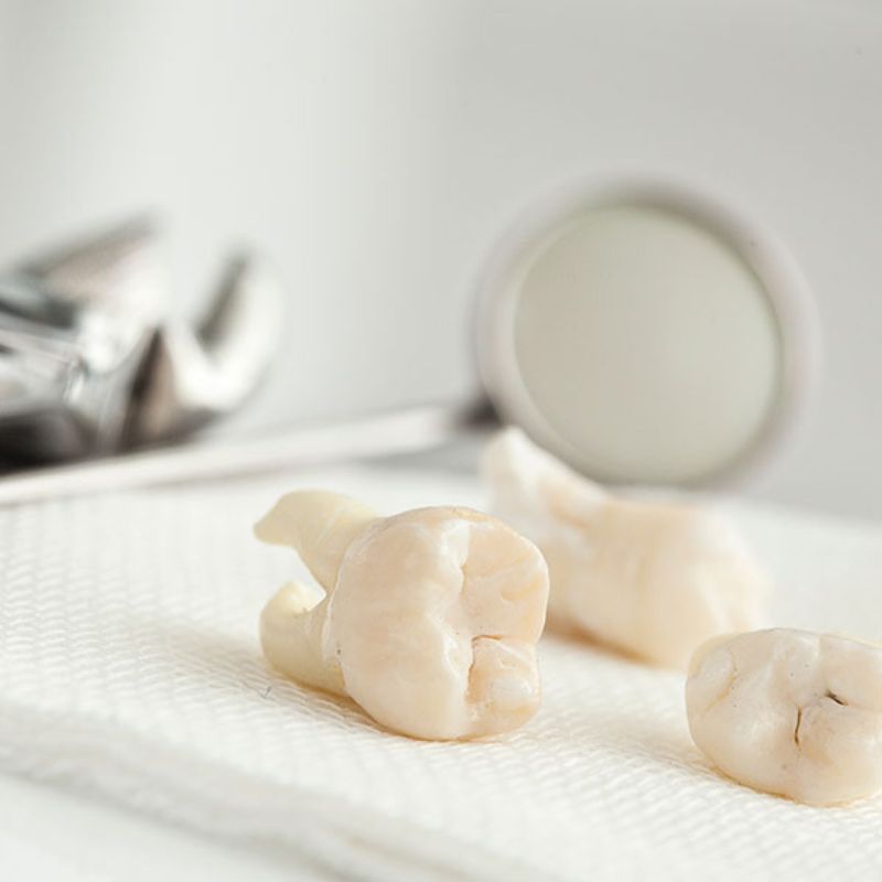 At Implant Network, we provide comprehensive dental extraction services, including the removal of wisdom teeth. Our procedures are designed to be as convenient and stress-free as possible. No referral is needed to schedule an appointment, and we welcome patients seeking a second opinion. All extractions are performed at standard general dentist fees, and we offer various sedation levels to ensure your comfort.