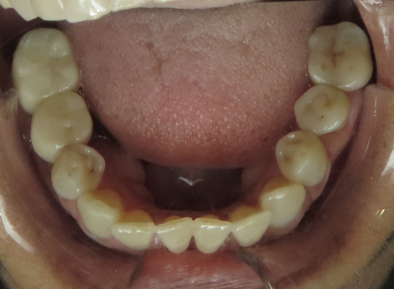 After Dental Implant