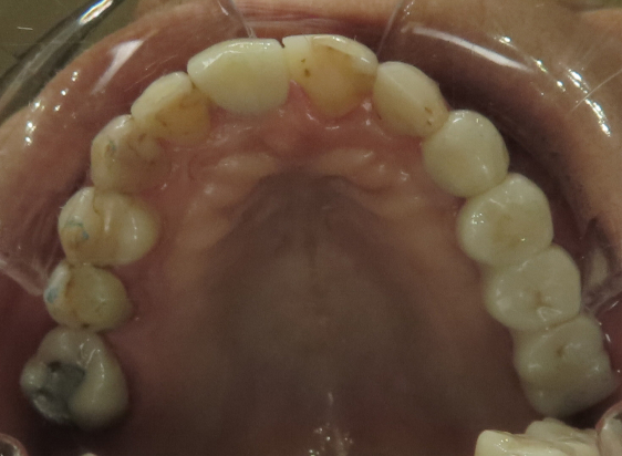 After Dental Implant