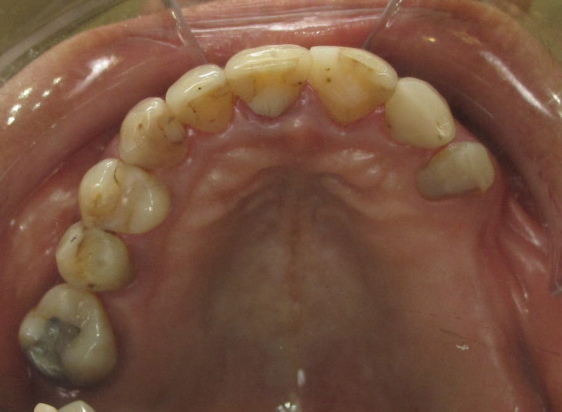 Before Dental Implant